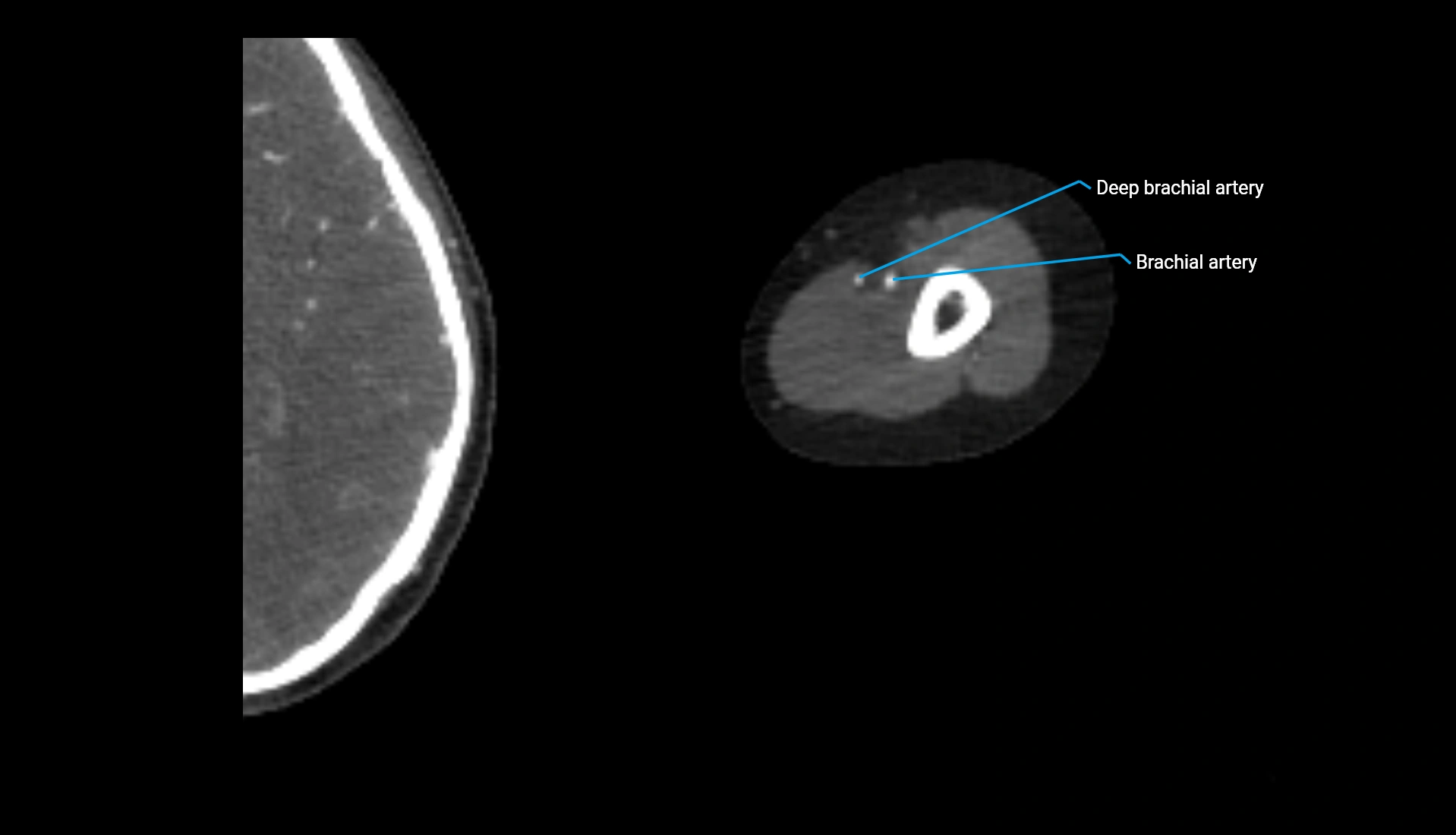 CTA upper limb axial cross sectional anatomy labelled image 242 (2).webp